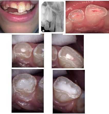 Direct pulp cap nerve exposure and pulpitis