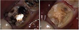 tooth decay and stain removal technique, dental filling bonding composite teeth restoration