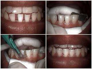 bonding gaps to close teeth tooth, technique smile mouth
