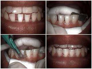 drilling procedure, how, technique, how to, bonding to close spaces, dentistry, composite resin