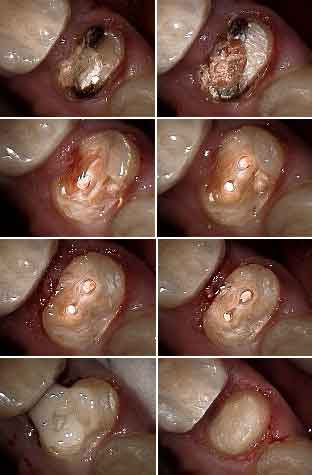 dental crown buildup, composite cores, bonding, crown lengthening, root canal, tooth structure