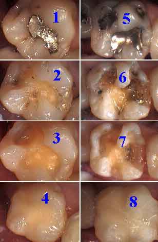 drilling teeth, drill tooth cavity, bonded dental, bonded cosmetic dentistry 