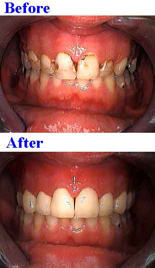 meth mouth crystal meth cocaine tooth decay crown drug abuse recurrent dental caries teeth