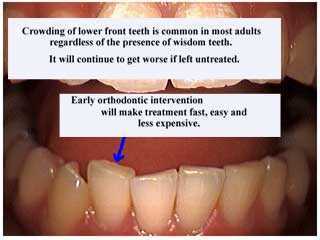 early intervention preventive interceptive Orthodontic theory how teeth braces dental how to explain
