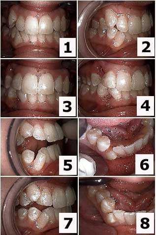Malocclusion, dental bite tooth occlusion teeth crooked crowded, pushed out, labial, extract canine