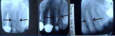 medication in dentistry, tooth resorption, MTA, mineral trioxide aggregate, before and after xrays