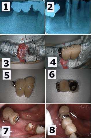 semi precision Attachment, dental precision, cervical decay, hemisection, tooth crown
