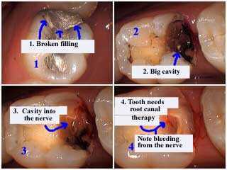 broken silver filling, tooth decay cavity teeth cavities, dental caries, root canal therapy