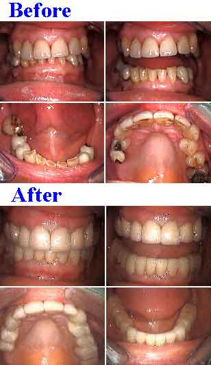tooth decay crown recurrent caries preventive full mouth root canal endodontics