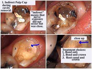 endodontics, root canal, prophylactic, preventive, intentional, indirect pulp cap