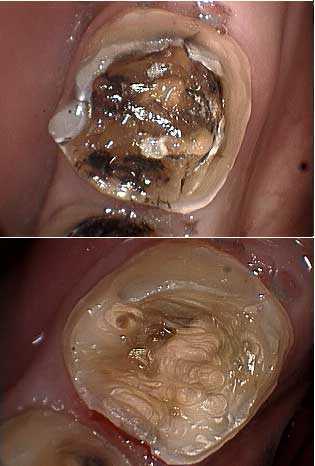 endodontics root canal problems complications calcification instrumentation obturation 