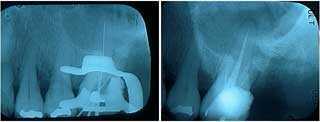 endodontics, root canal lengths x-rays pain infection tooth teeth abscess decay cavity swollen