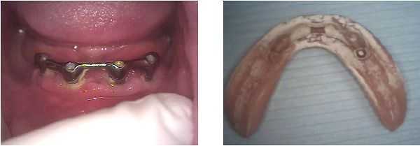 Epulis Fissuratum Dental implant denture, plaque, calculus, broken, infection