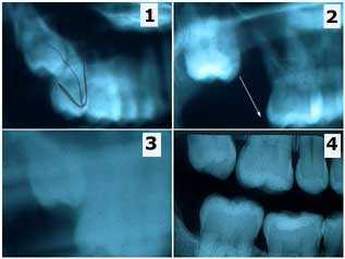 mesial drifting tooth teeth drift Wisdom eruption pattern occlusion bite extraction error x-ray