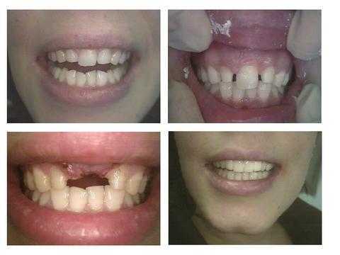 aesthetic dentistry, Janet, Missing One Central Incisor Front Tooth, cosmetic dentistry Dr. Dorfman, Ribbond smile