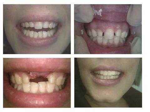 space analysis, arch length measurement, teeth spacing, One Front Tooth, Central Incisor