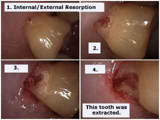 external resorption internal symptoms tooth extraction diagnosis treatment hopeless