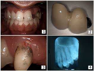 Dentistry Bridge Repair, fix Tooth Radiograph, External Resorption, Gingival Margin broken