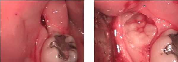 Extraction of an impacted mandibular wisdom tooth, sulcular incision, retromolar pad