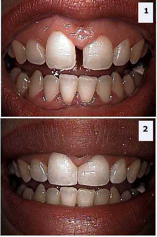 NY smile makeovers make over shows bonding a diastema or tooth gap