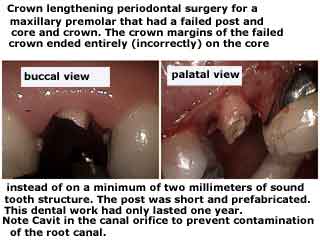 failed Post and Core failure fell out off prefabricated posts, cast gold gum surgery, gingiva
