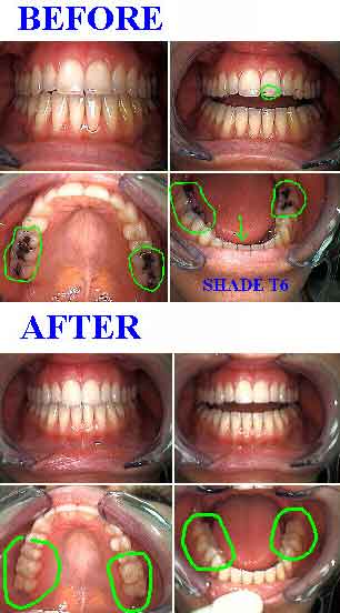 fast dentist, quick, one visit operative four quadrant dentistry, esthetic cosmetic teeth bonding