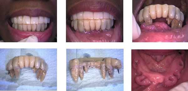 Fear of dentists, dental fear, scared of dentistry, epulis fissuratum, dental implants, teeth ext