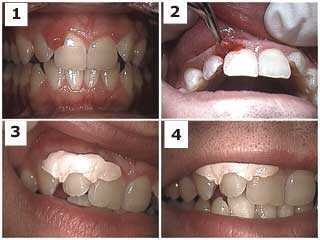 periodontal therapy fibroma, papilla, hyperplasia, growth, gum problems, complications