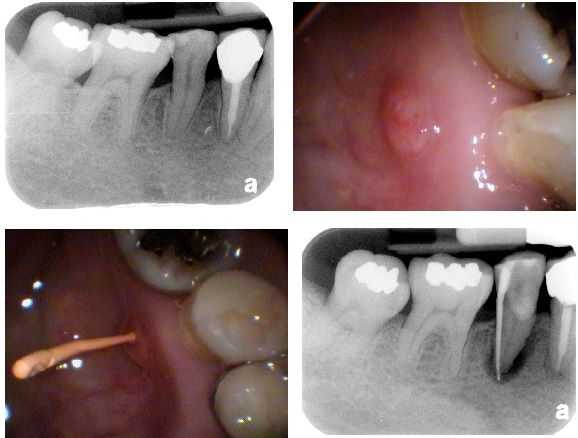 Fistula, Gum Boil, Gum Pimple, Gum Bump, Periapical Abscess diagnosis.