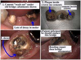 fix tooth bridge caps crowns repair, cement leakage, wash out under dental bridges