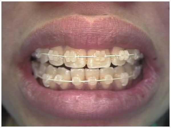 cosmetic clear braces, Fixed orthodontics, white brackets and arch wires tooth colored, Nitinol