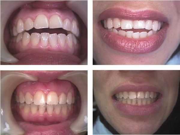 Fixed orthodontics using dental clear braces closes an anterior open bite.