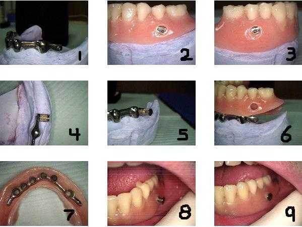 Fixed removable dental implant prosthesis, implant denture hybrid, Lew Attachments