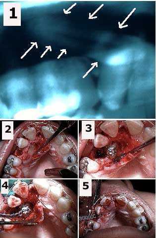 impacted palatal tooth impaction
