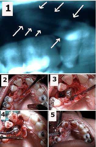 missing teeth tooth impaction, impacted, canine oral surgery braces orthodontics treatment options