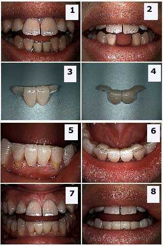 Maryland Bridge, porcelain metal tooth teeth ceramic, Full mouth reconstruction, pfm Kristobal Fixed Bridge, Cristobal, partial 