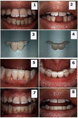 framework, tooth bridges, dental caps Maryland Bridge, partial denture, frame work crowns photos