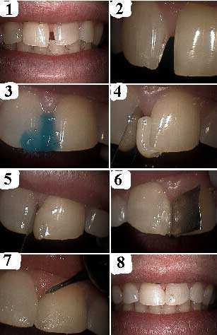 cosmetic bonding to close diastema, dentistry technique method intra oral composite