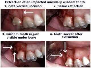 Wisdom teeth extraction full bony impactions, Wisdom Teeth Tooth, third 3rd molar, removal surgical extraction cyst