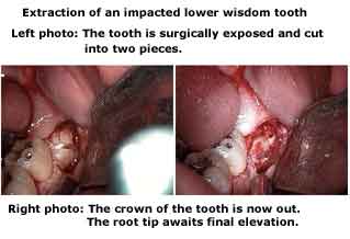 Wisdom teeth extraction full bony impactions, Wisdom Tooth, third 3rd molar, oral surgery surgical, removal, exodontia