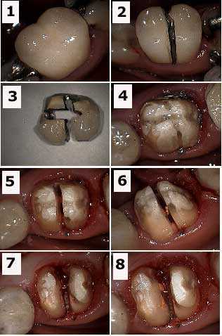 furcation involvement, tooth root hemisection, root resection, crown removal, crown lengthening gum