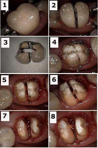 evaluation, alveolar ridge, cortical plate, furcation involvement, hemisection, root resection crown