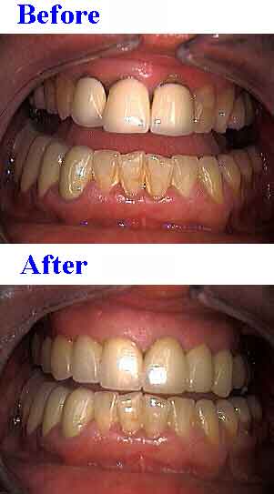 replacing dental crowns teeth caps dark black gums stain gum dark periodontics gingivitis perio