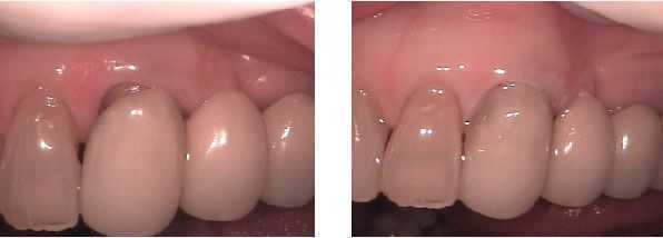 gingival recession, crown and bridge margin, darkness black gumline, gum recession, receded gums