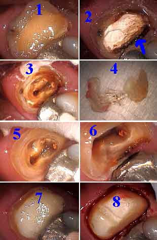 gingivectomy, cutting gum tissue, gv periodontal surgery removal cut gingiva how to pictures