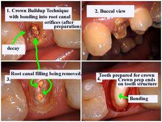 dental crown buildup build-up tooth decay teeth cavity caries root canal orifices