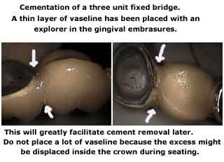 glass ionomer crown dental cement, porcelain pfm cap bridge luting agent cementation teeth