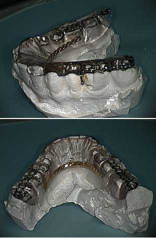 grinding teeth, bruxism, mandibular stabilizing appliance, myalgia, myositis, Hawley bite plate