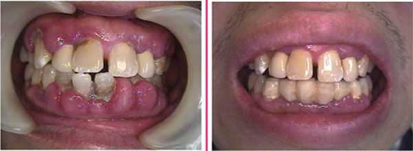 Calcium channel blockers cause gum disease or gums hyperplasia. Infection from Azor causes gingivitis symptoms and needs treatment.
