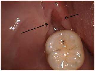 distal wedge, pericorium, pericoronitis, gum, periodontal periodontia surgery problems